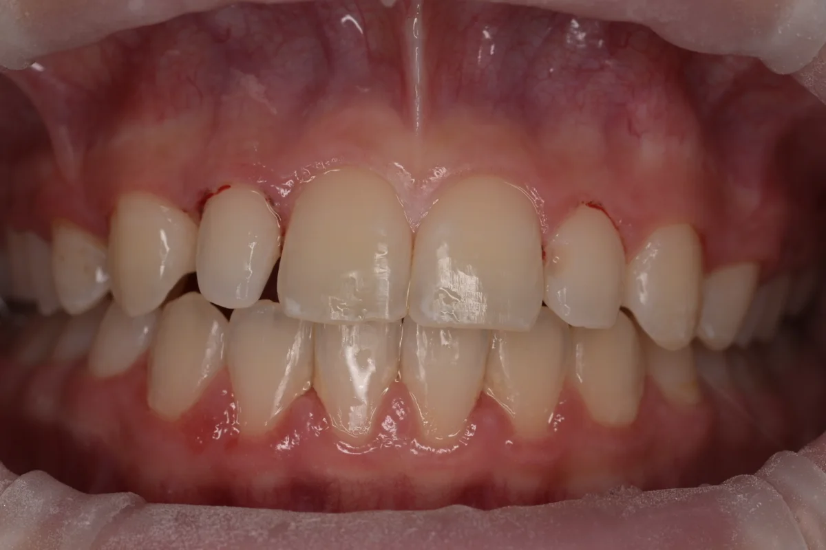 Before composite bonding for peg lateral teeth at MDRN Dental Studio