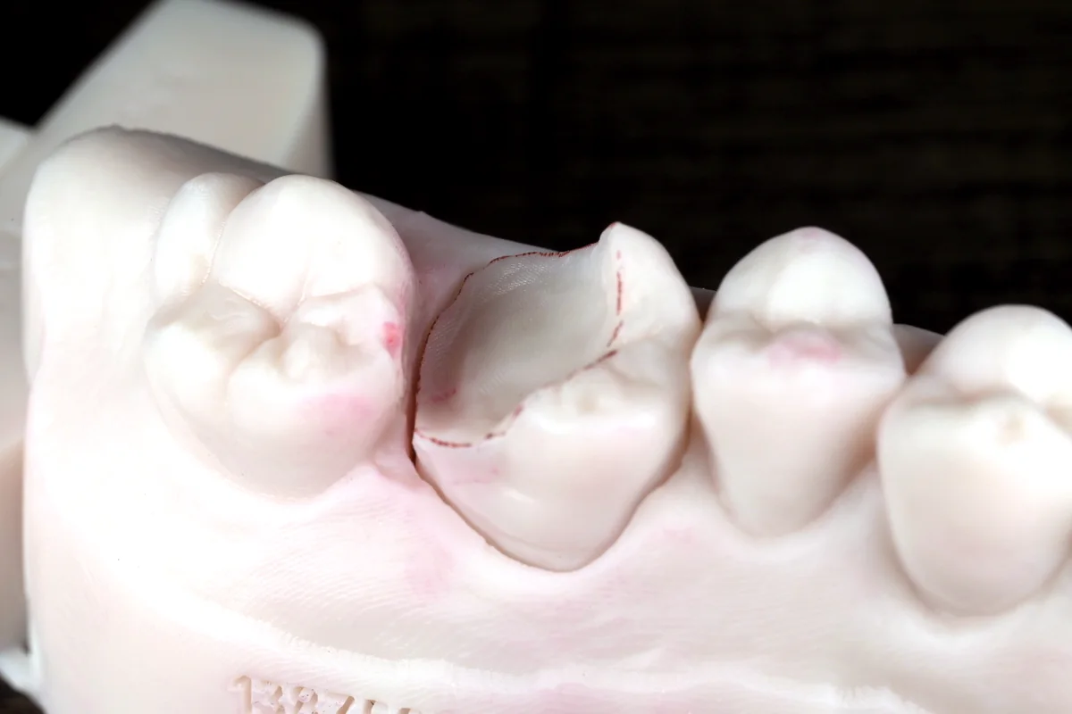 De-identified MDRN Dental Studio onlay case showing partial coverage design on a back tooth model