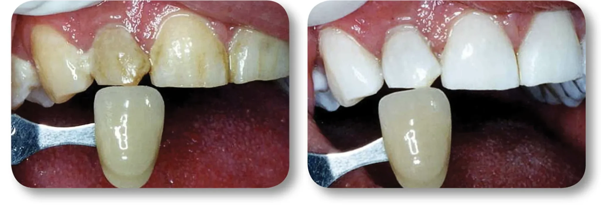 KöR whitening before and after example 2