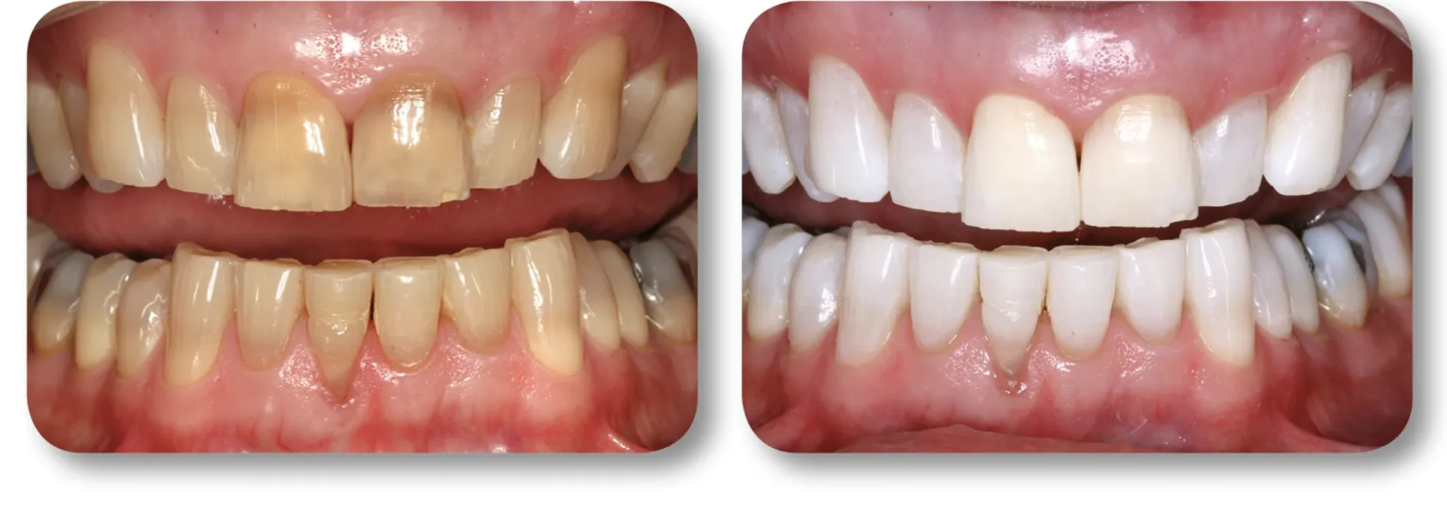 KöR whitening before and after example 3