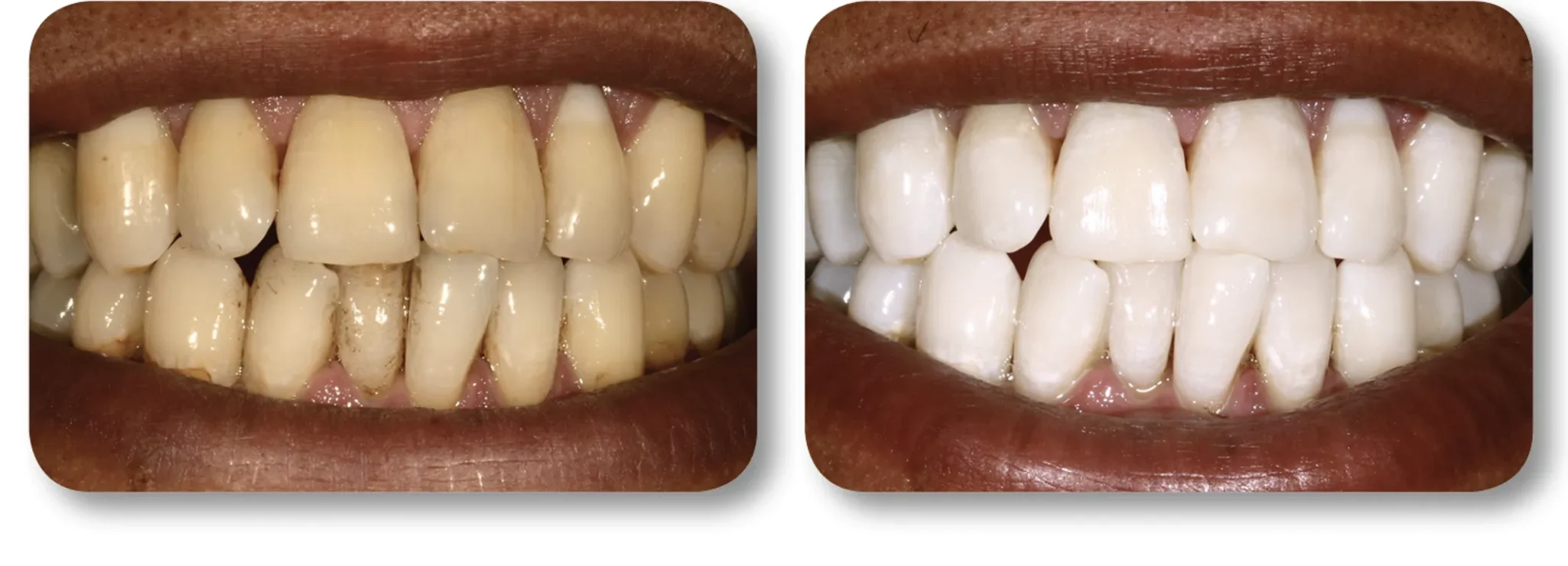 KöR whitening before and after example 4