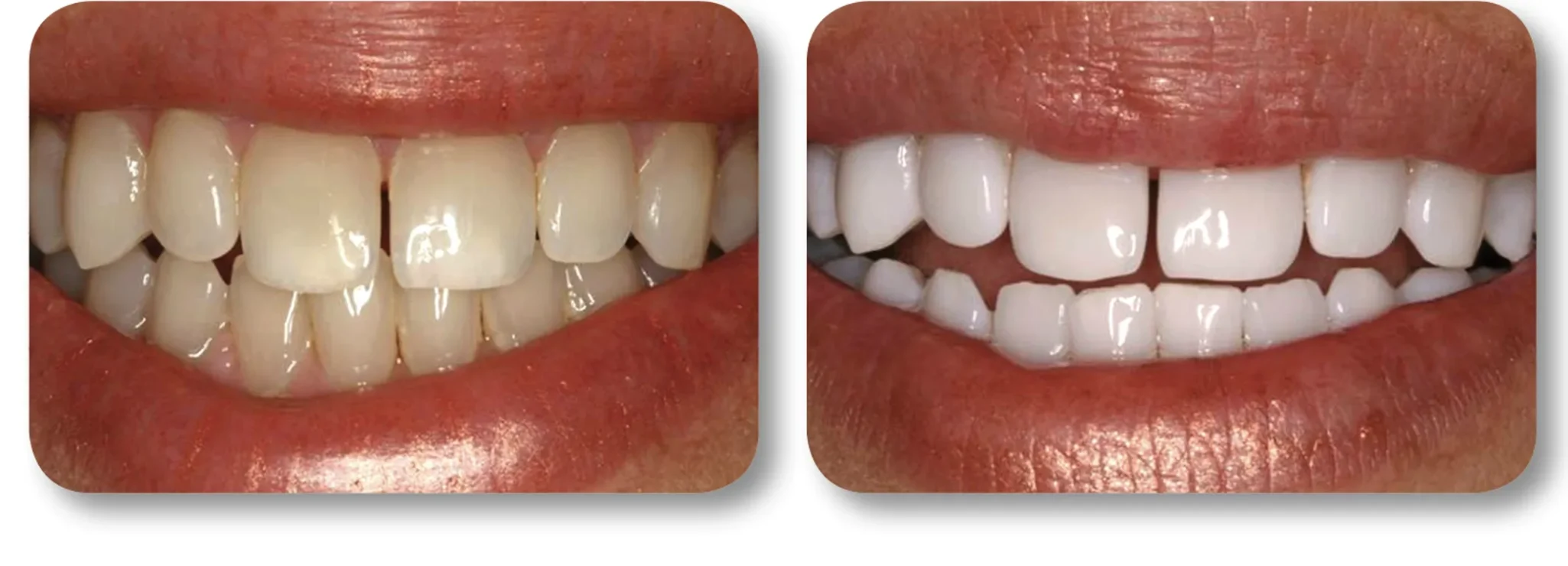 KöR whitening before and after example 5