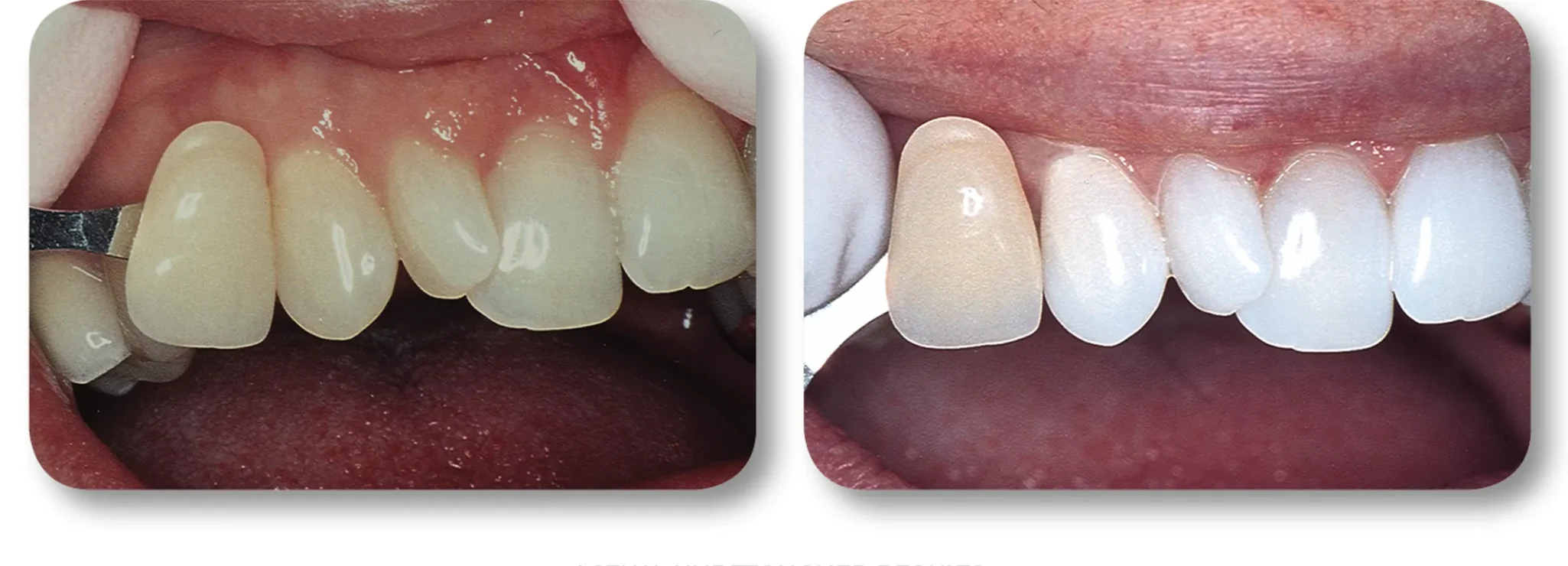 KöR whitening before and after example 6