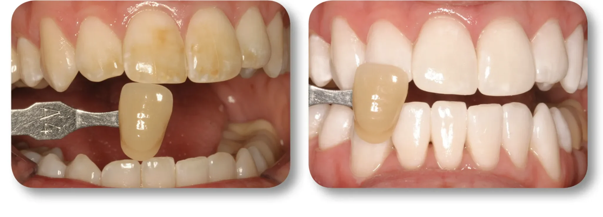 KöR whitening before and after example 1